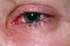 How to Treat Eye Irritation Thumbnail of How to Treat Eye Irritation