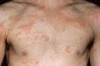 How to Treat Rashes on Body Thumbnail of How to Treat Rashes on Body