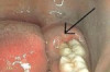 How to Stop Wisdom Tooth Swelling Thumbnail of How to Stop Wisdom Tooth Swelling
