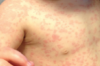 Maculopapular Rash Treatment Thumbnail of Maculopapular Rash Treatment