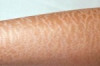 How to Treat Xerosis Thumbnail of How to Treat Xerosis