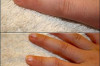 Home Remedies for Juvenile Rheumatoid Arthritis Thumbnail of Home Remedies for Juvenile Rheumatoid Arthritis