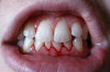 Home Remedies to Stop Bleeding Gums Thumbnail of Home Remedies to Stop Bleeding Gums