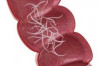 Home Remedies for Pinworms Thumbnail of Home Remedies for Pinworms