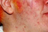 Home Remedies for Pock Marks Thumbnail of Home Remedies for Pock Marks