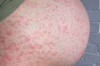 Home Remedies for Rashes During Pregnancy Thumbnail of Home Remedies for Rashes During Pregnancy