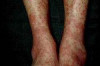 How to Treat Vasculitis Thumbnail of How to Treat Vasculitis