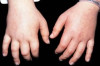 Water Retention Home Remedies Thumbnail of Water Retention Home Remedies