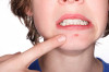 Overnight Home Remedies for Zits Thumbnail of Overnight Home Remedies for Zits