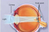 What is Astigmatism, Symptoms, Causes, and Treatment? Thumbnail of What is Astigmatism, Symptoms, Causes, and Treatment?