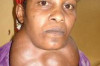 Goitre Causes, Signs & Symptoms, and Treatment Thumbnail of Goitre Causes, Signs & Symptoms, and Treatment