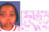 Thalassemia (A Genetic Blood Disorder) Symptoms and Treatment Thumbnail of Thalassemia (A Genetic Blood Disorder) Symptoms and Treatment