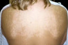 How to Get Rid of White Spots on Skin Thumbnail of How to Get Rid of White Spots on Skin