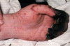 Sepsis (Blood Infection) Symptoms and Treatment Thumbnail of Sepsis (Blood Infection) Symptoms and Treatment