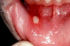 Thumbnail of Singaw (Canker Sores) Home Remedies – How to Cure Singaw