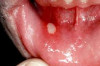 Singaw (Canker Sores) Home Remedies – How to Cure Singaw Thumbnail of Singaw (Canker Sores) Home Remedies – How to Cure Singaw