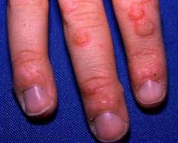 How to Get Rid of Warts Naturally