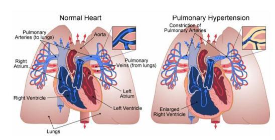 Signs of Primary Pulmonary Hypertension
