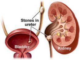 Coke and Asparagus Kidney Stone Remedy