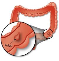 Colon Cancer Early Signs and Symptoms