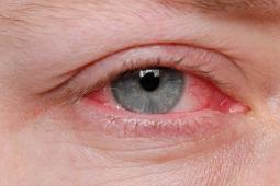 How Do i Get rid of Pink Eye