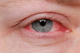 How Do i Get rid of Pink Eye