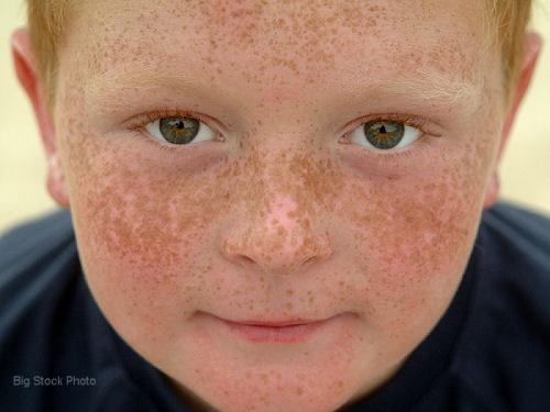 How to Remove Freckles Naturally