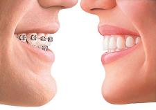 Invisalign Braces Cost in the Philippines