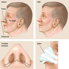 How nose job is done