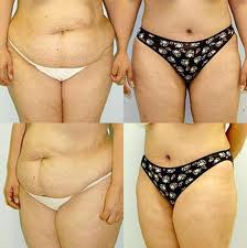 Abdominoplasty Tummy Tuck Cost