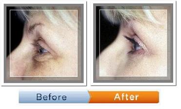 Blepharoplasty befor and after