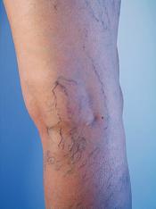 Cure Varicose Veins Naturally