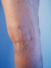 Cure Varicose Veins Naturally