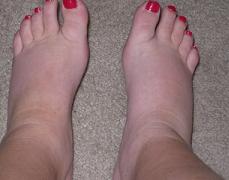 Reduce Swelling Feet