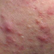 acne vulgaris home treatment