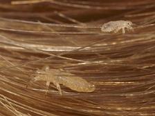 head lice picture