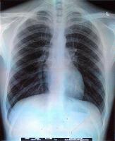 how tuberculosis is transmitted