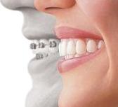 invisalign cost in canada