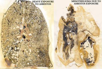 mesothelioma cancer lungs