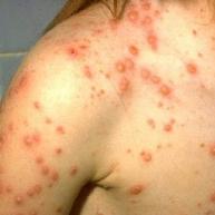 remove chicken pox marks scars