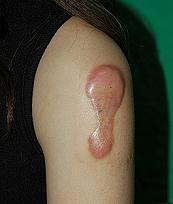 How to Remove Keloid Scars
