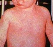 Treat Measles in Children