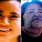 Hang Mioku's Face - Before and After Plastic Surgery