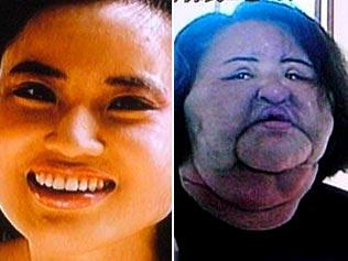 korean woman hang mioku after injecting cooking oil on her face
