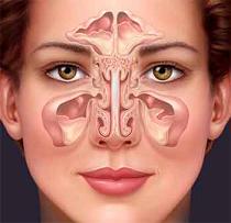 sinusitis home remedies