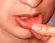 treat mouth sores