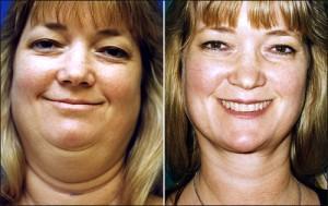 Lose Double Chin Fat Fast