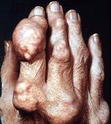 Prevention for Gout Attacks