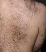 Remove Unwanted Back Hair