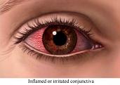 Treat Eye Infection